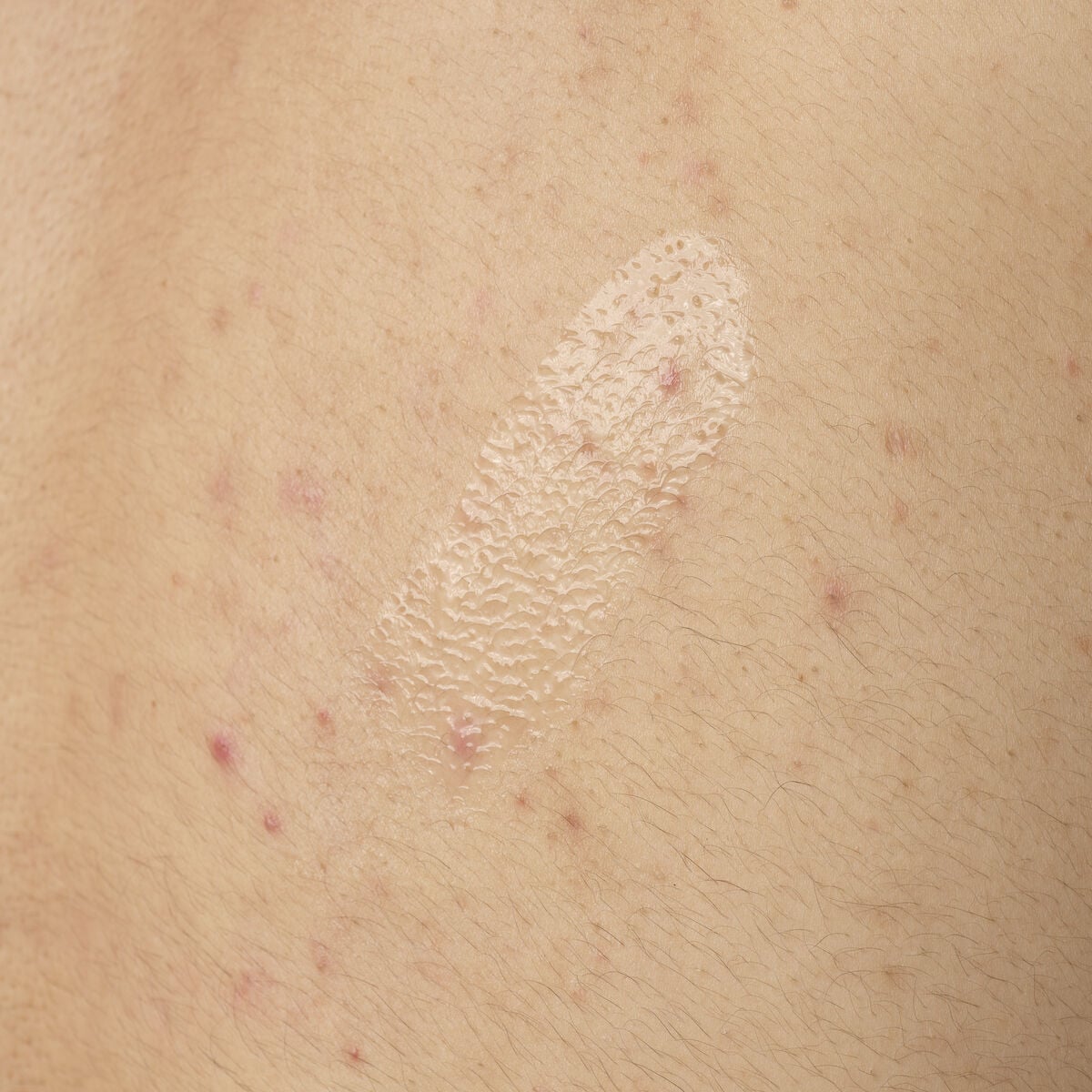 salicylic-acid-0-5-body-serum-r2 ORD-salicylic-acid-05-body-240ml-application.jpg