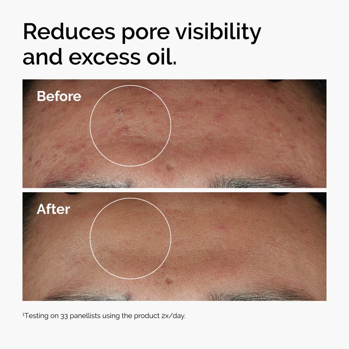 niacinamide-10-zinc-1-t2 ord-niacinamide-zinc-blemish-serum-before-after-pores.jpg