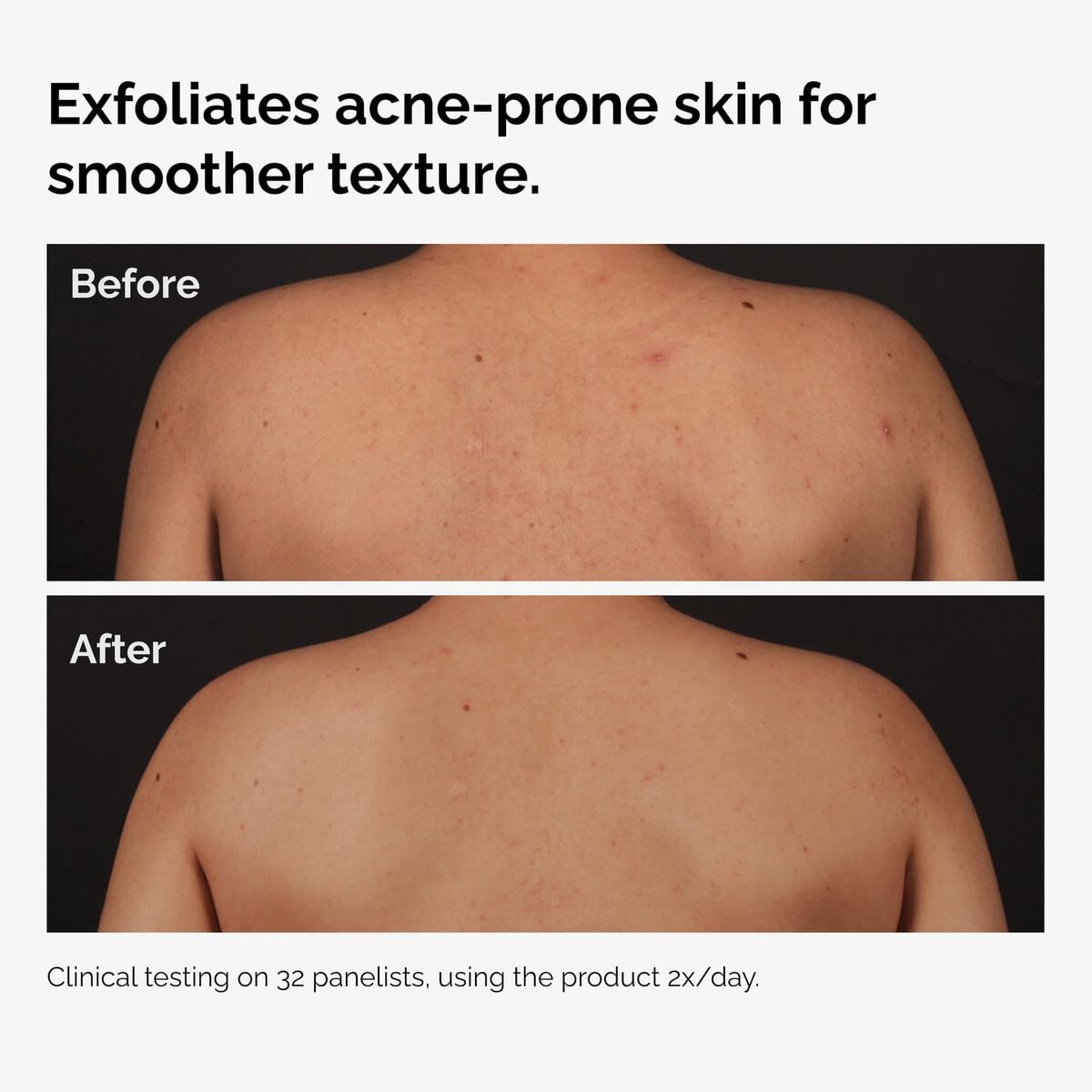 salicylic-acid-0-5-body-serum-r2 ord-salicylic-acid-body-serum-before-after-graphic-NA.jpg