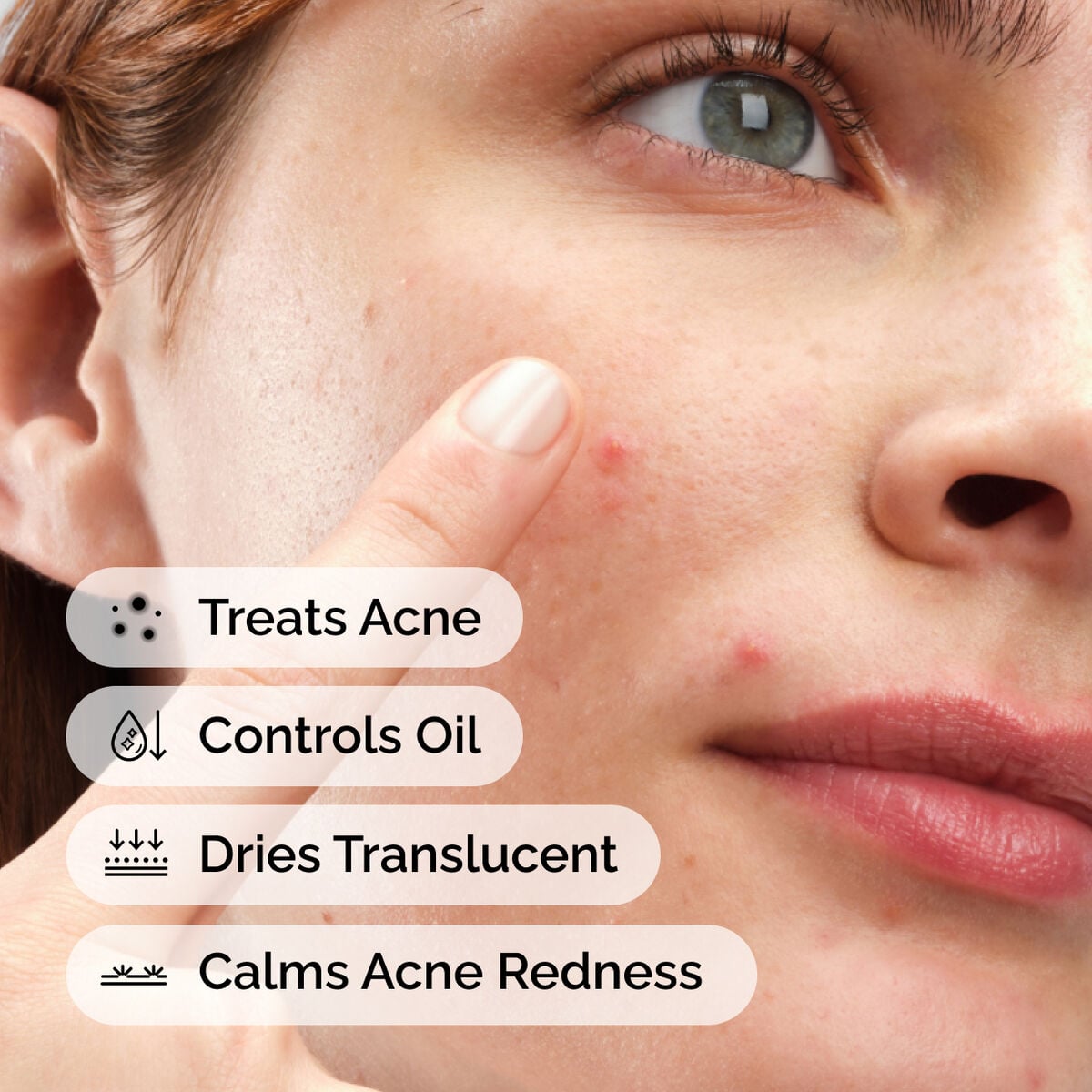 sulfur-10-powder-to-cream-concentrate-o0 ord-sulfur-10pct-powder-to-cream-concentrate-model-application-with-benefits-acne.jpg