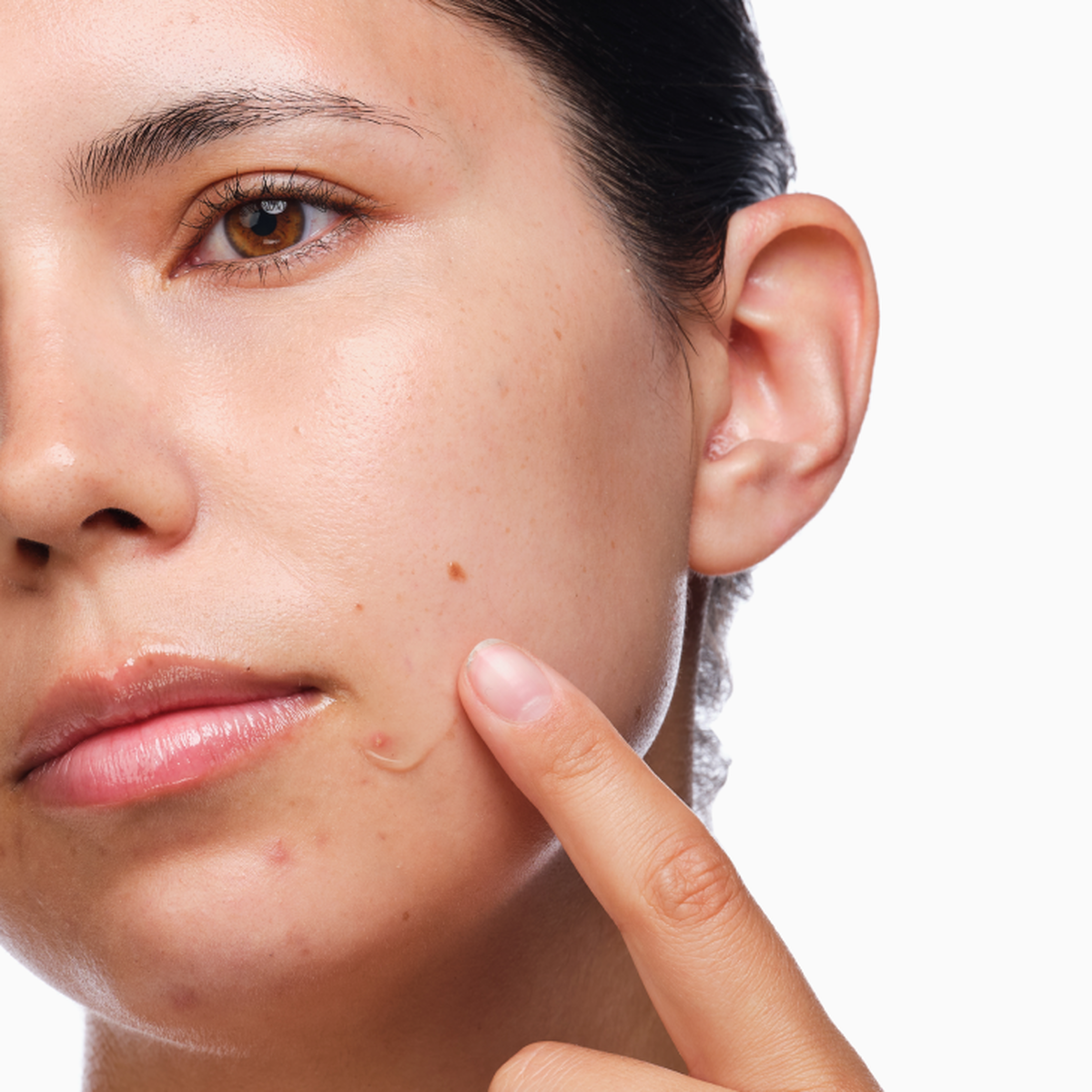 the-acne-set-i3 rdn-the-acne-set-application.png